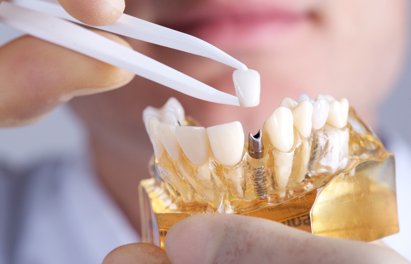 Dental Implants in India